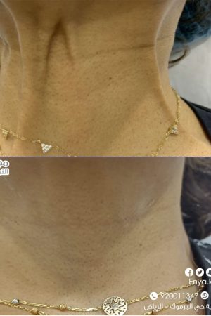 نتيجة قبل وبعد في عيادة الجلدية والتجميل بمجمع العناية النموذجية الطبي رقم 2