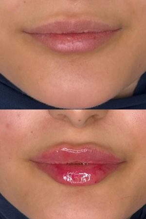 نتيجة قبل وبعد في عيادة الجلدية والتجميل بمجمع العناية النموذجية الطبي رقم 4