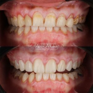 نتيجة علاج وتجميل أسنان (قبل وبعد) في مجمع العناية النموذجية الطبي رقم 10