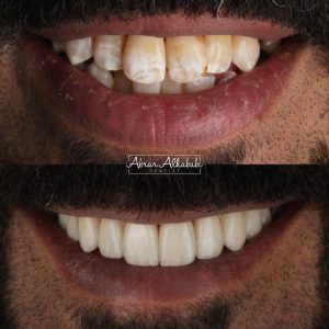 نتيجة علاج وتجميل أسنان (قبل وبعد) في مجمع العناية النموذجية الطبي رقم 11