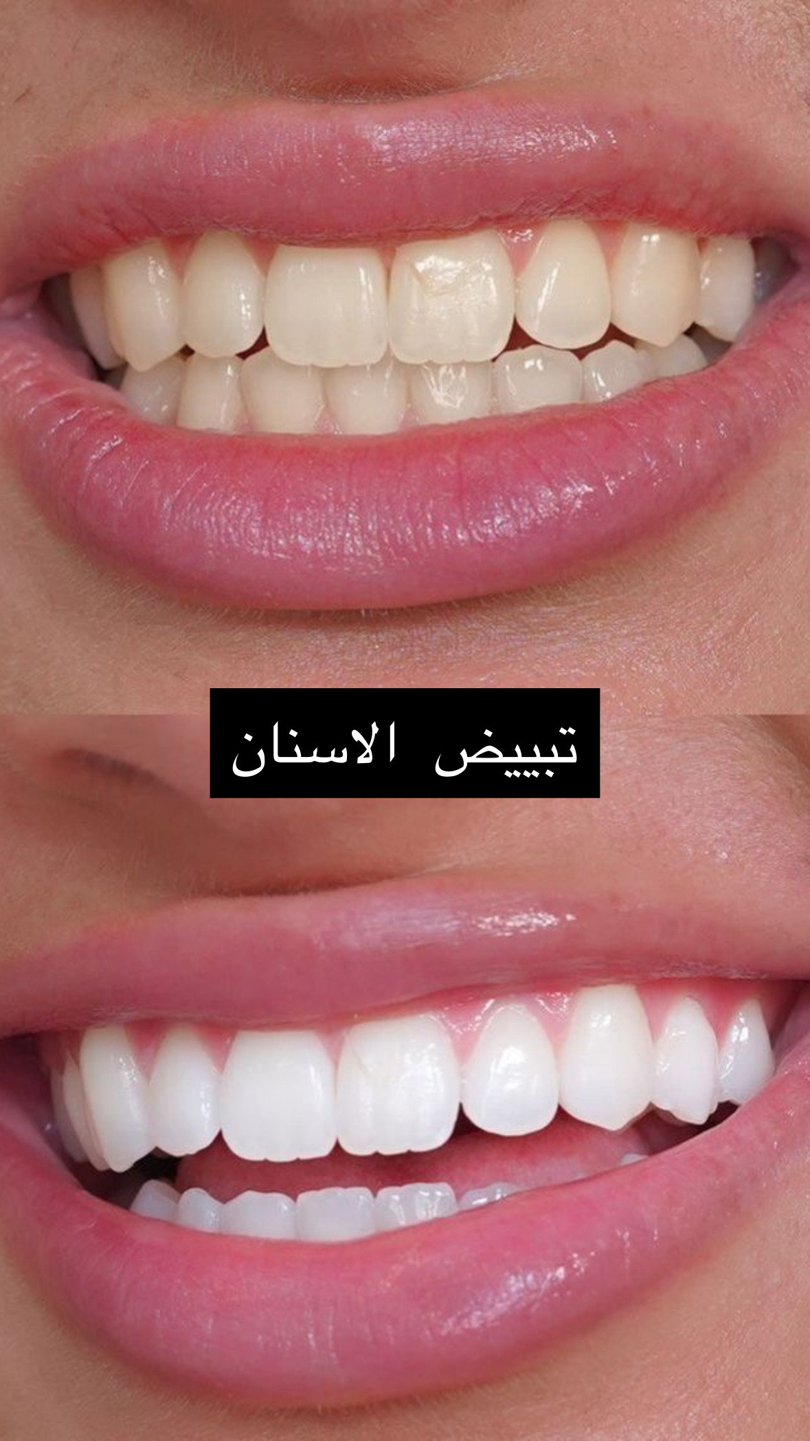 نتيجة علاج وتجميل أسنان (قبل وبعد) في مجمع العناية النموذجية الطبي رقم 5